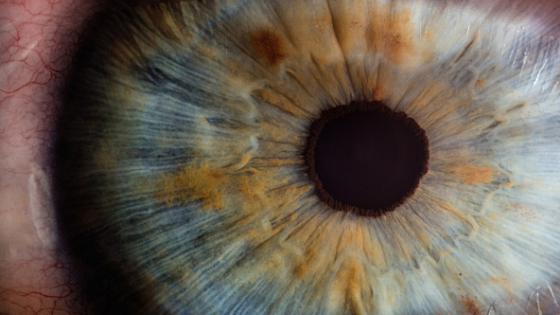 glaucoma